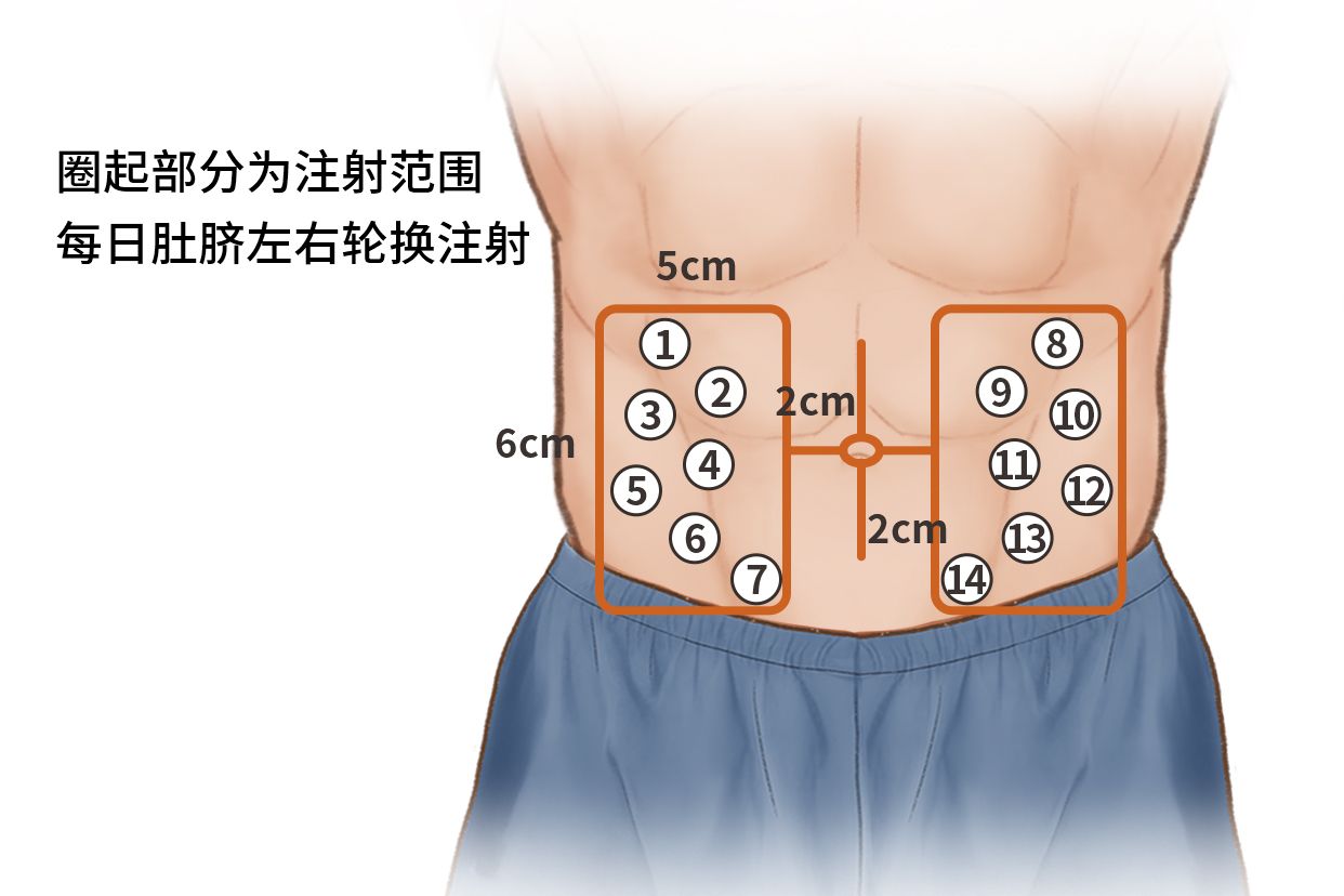 脐周注射的位置图片