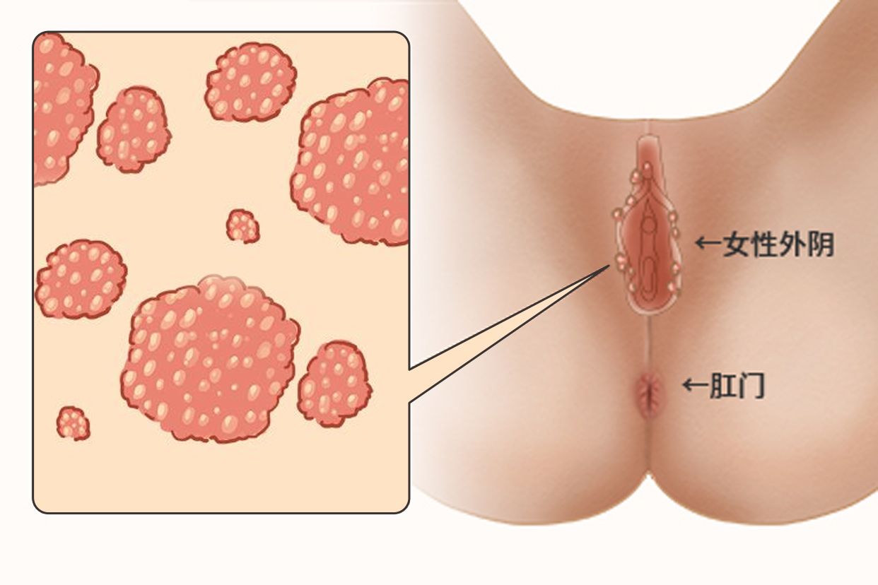 女性假性尖锐湿疣图