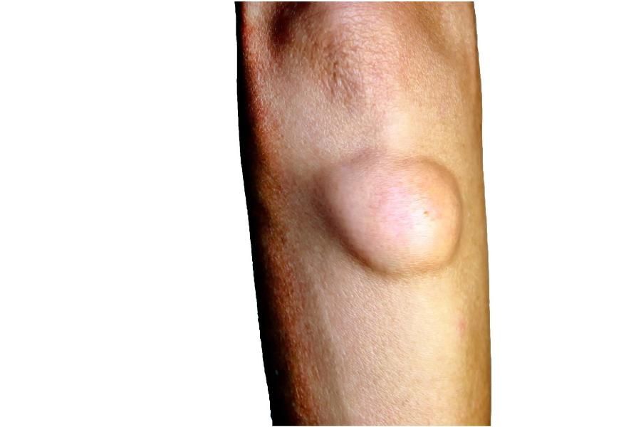 小腿外侧脂肪瘤图片图片