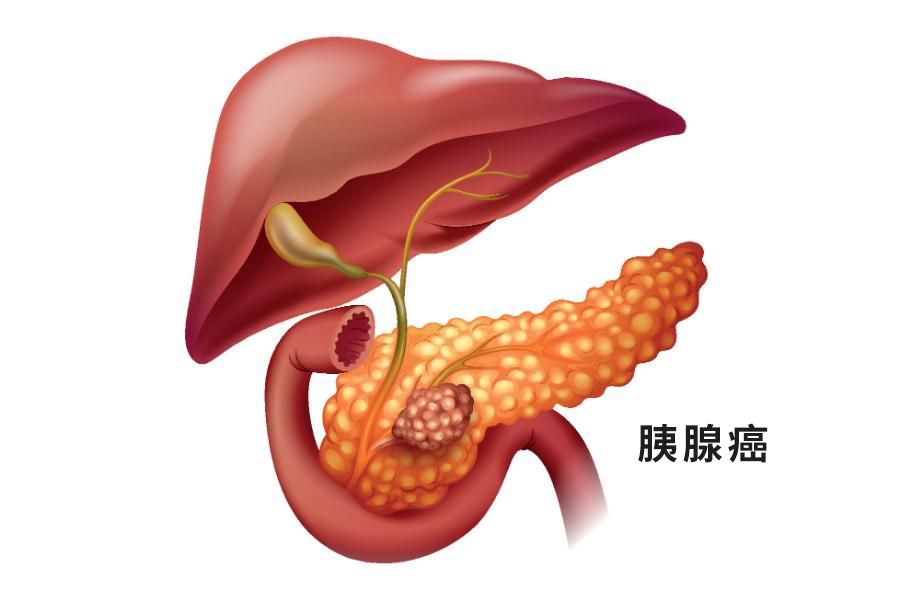 胰腺癌图片