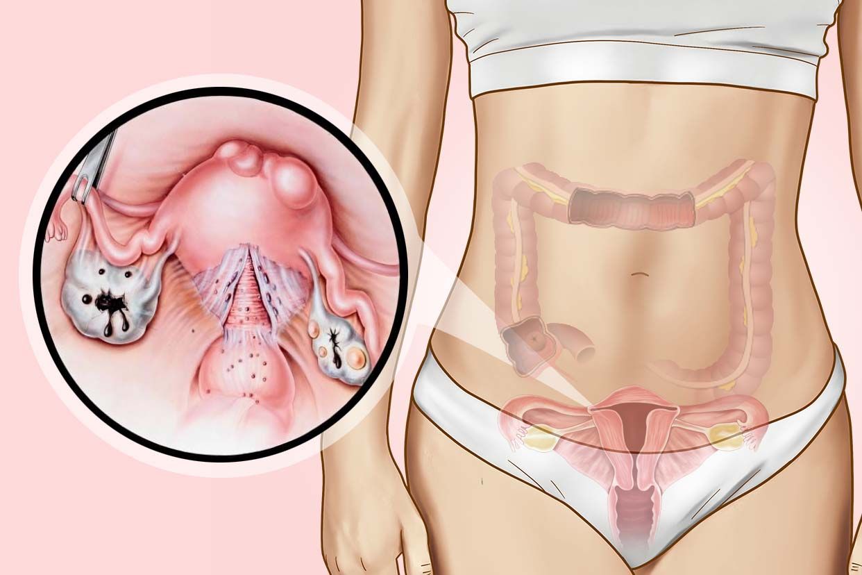 直肠子宫内膜异位症图片