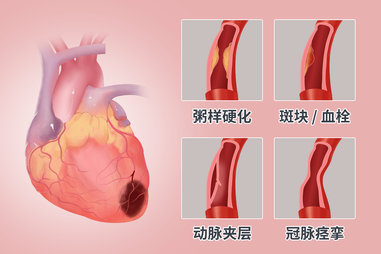 心肌梗死图