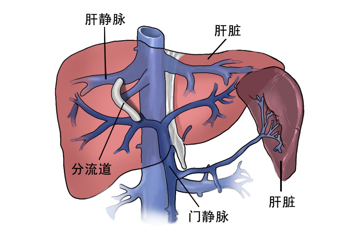 门脉性肝硬化手绘图