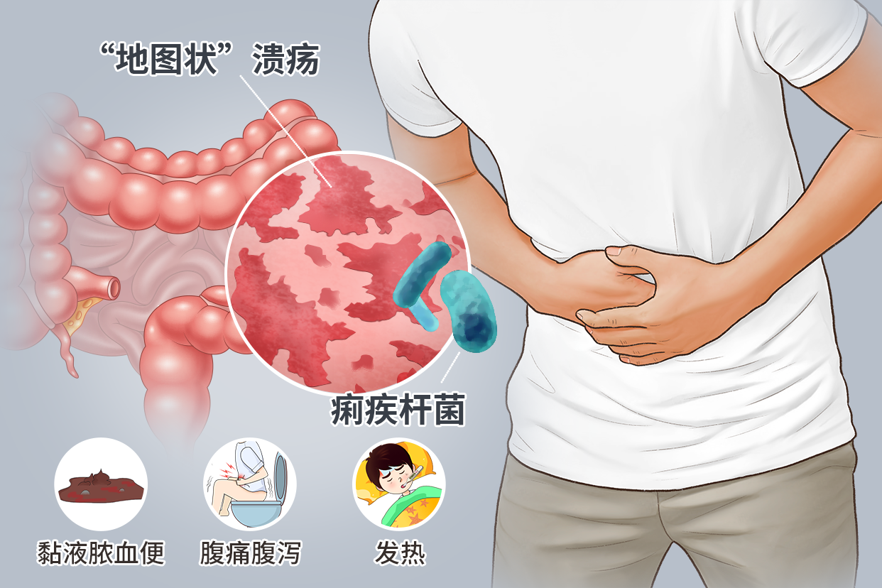 白痢疾的症状图片_39健康网_精编内容