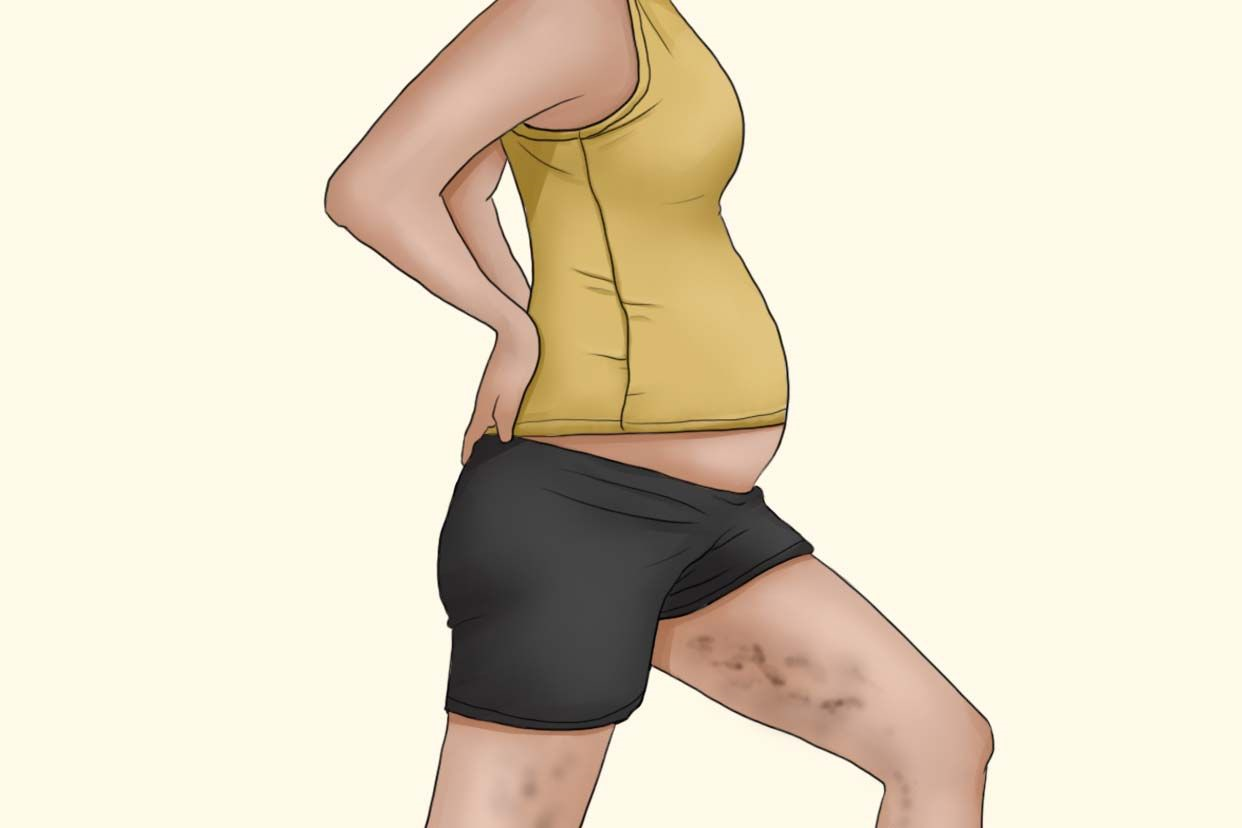 女性怀孕大腿两边变黑可能是由于激素水平改变,大腿肥胖,疾病因素等