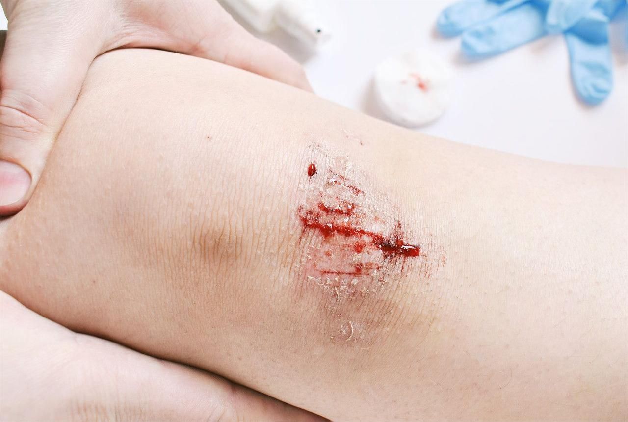 女生腿磕破出血图片