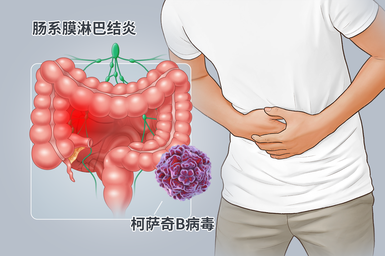 肠系膜淋巴结炎图片