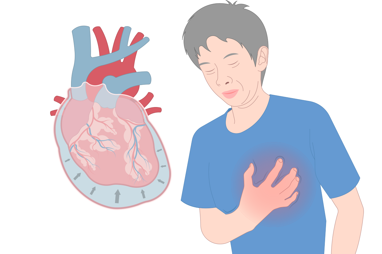 心包积液的病因分为感染性和非感染性两种,感染性原因包括细菌感染