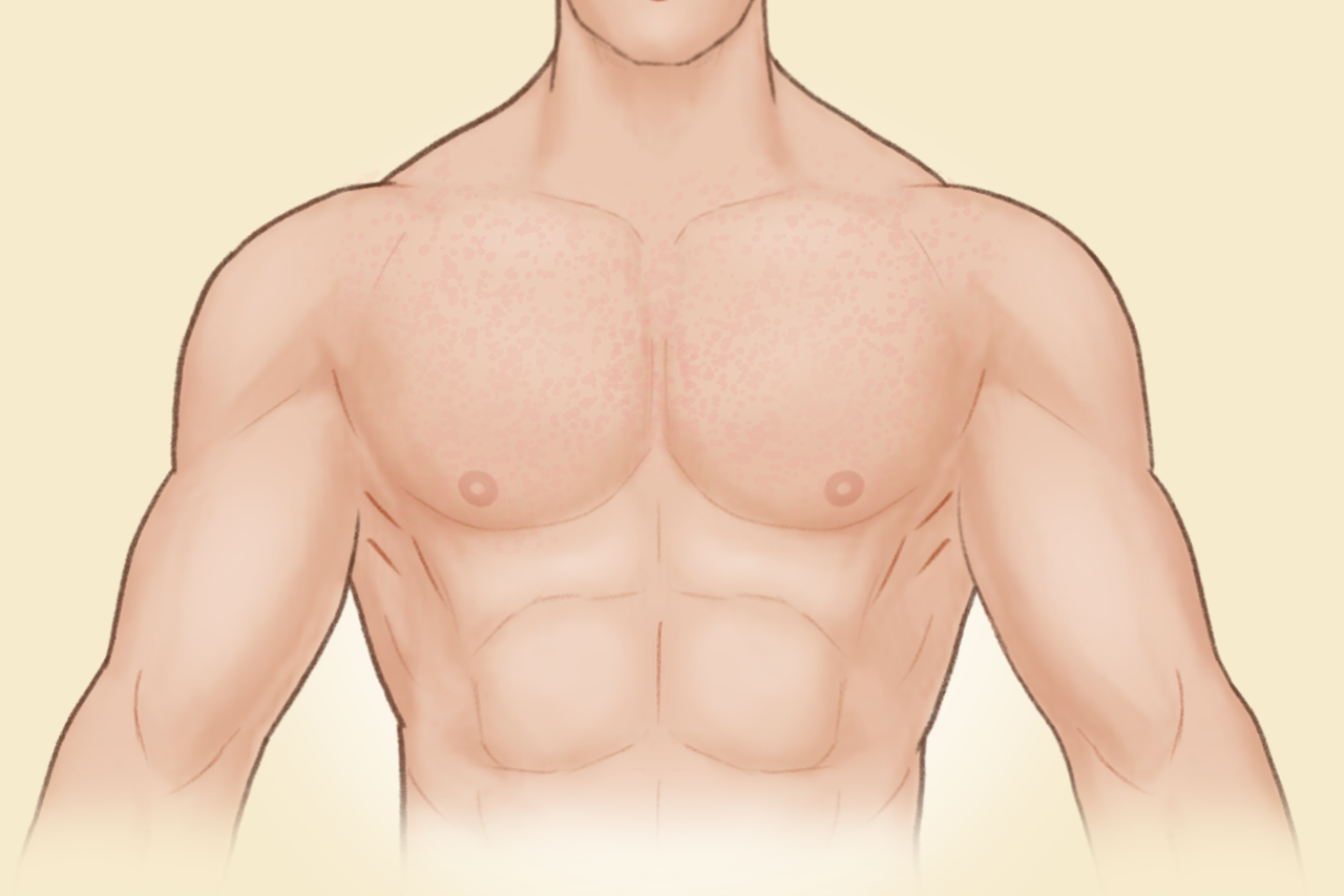 胸口汗斑初期图片