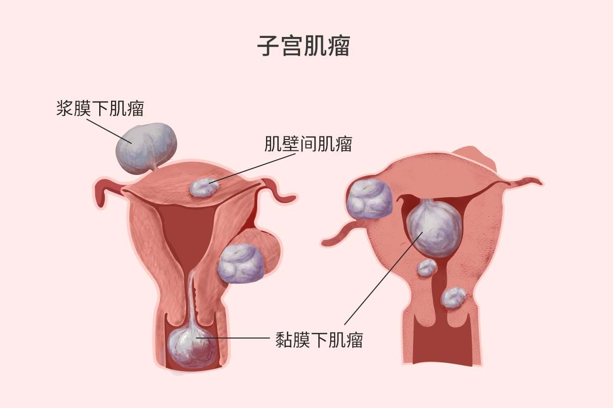 子宫肌瘤分类示意图