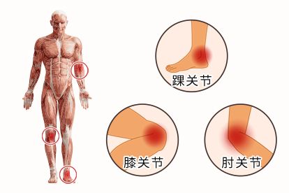 肌腱炎图片