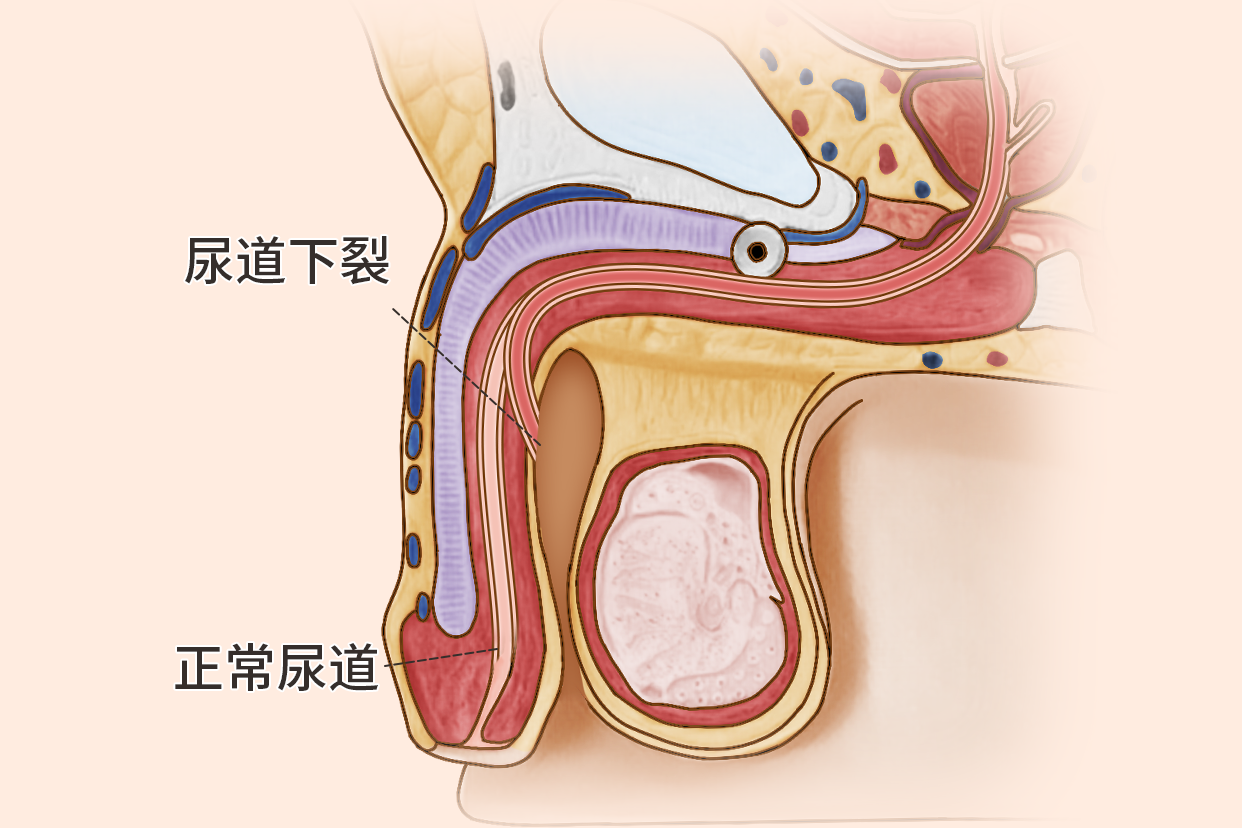 尿道下裂是一种常见的尿道先天畸形,是胚胎发育异常所致