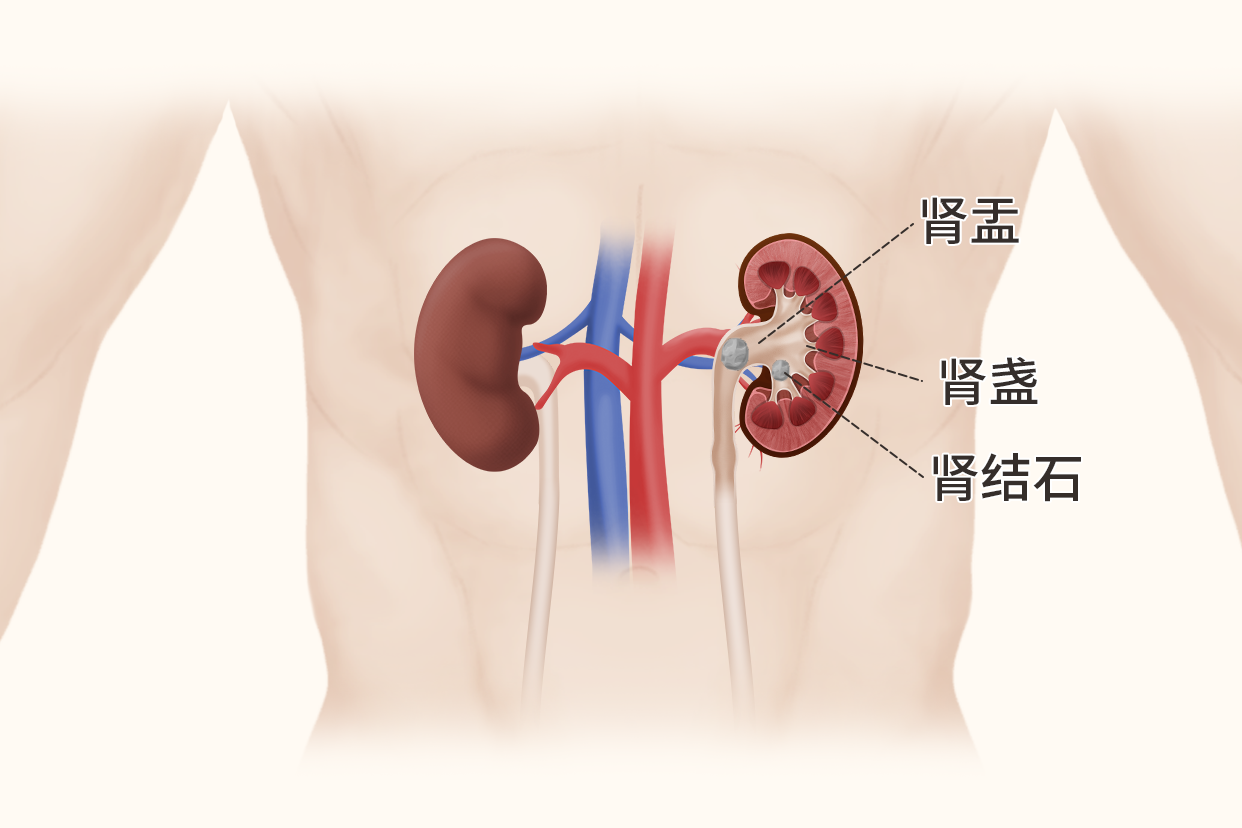 肾结石位置图片