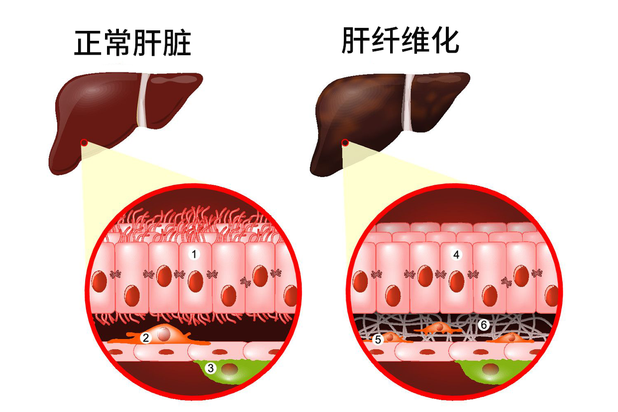 肝纤维化图片