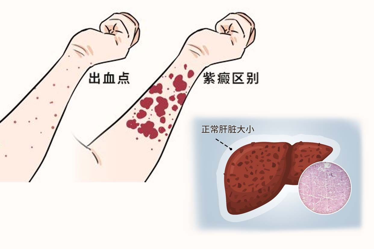 肝硬化皮下出血图片