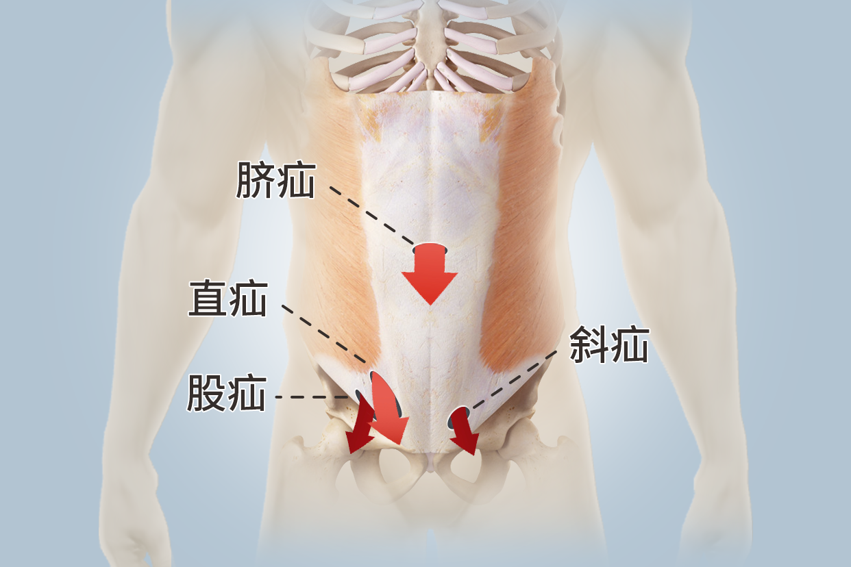 腹外疝的四种类型图