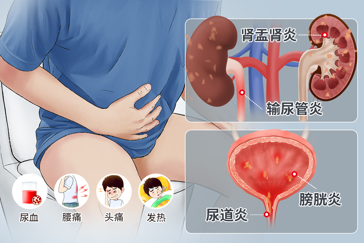 尿路感染症状图片