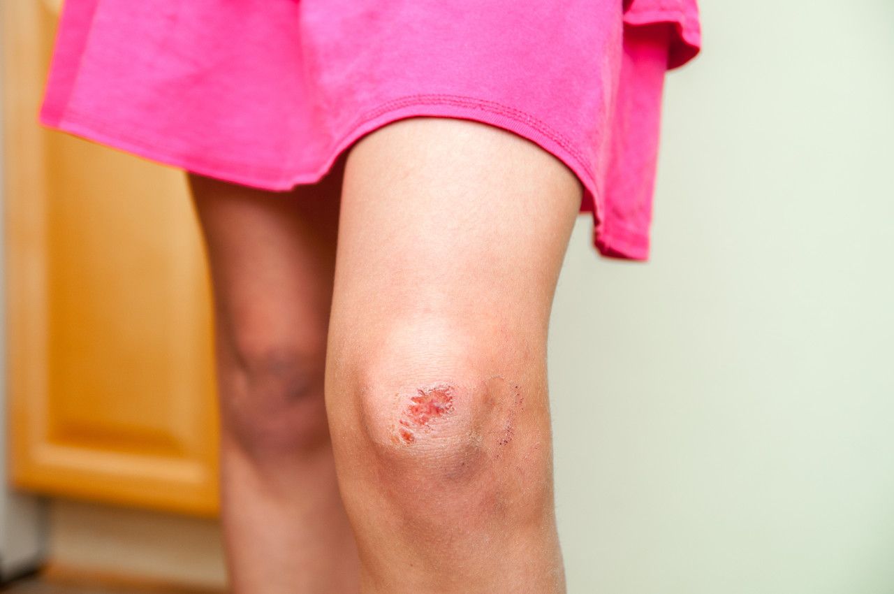 女生膝盖磕破流血图片