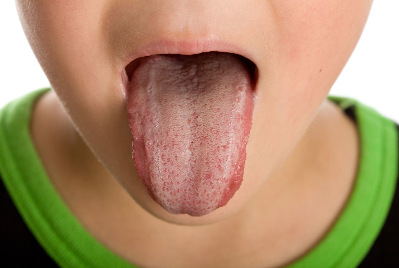 舌苔厚腻图片