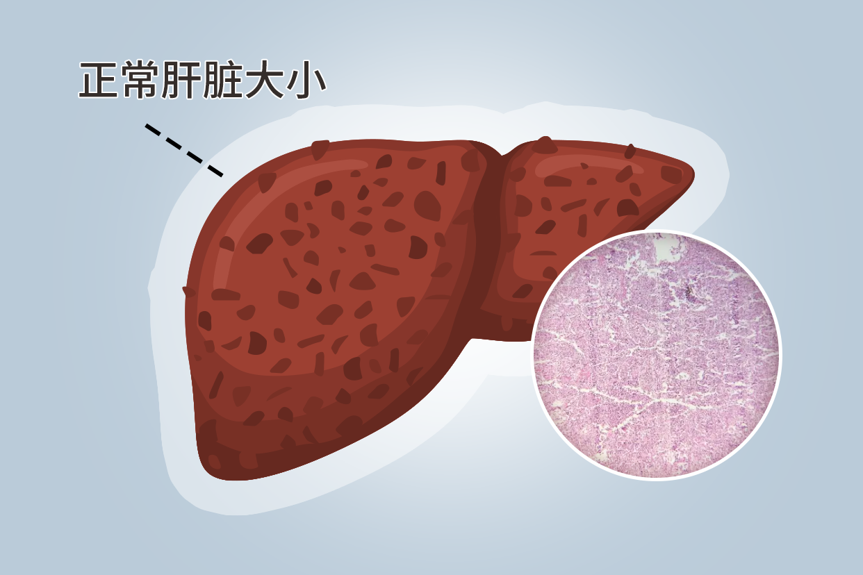 肝硬化显微镜下图片