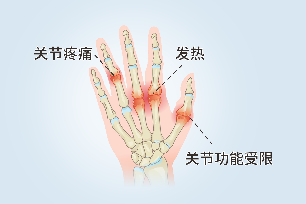 手指滑膜炎症状图片