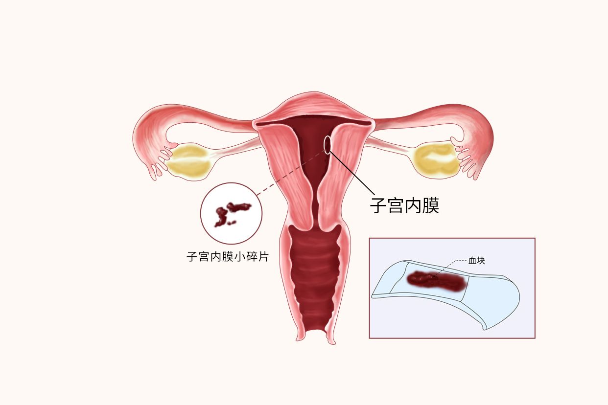 子宫内膜和血块的区别图片