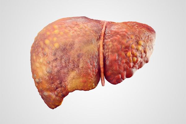 胆汁淤积性肝硬化图片图片