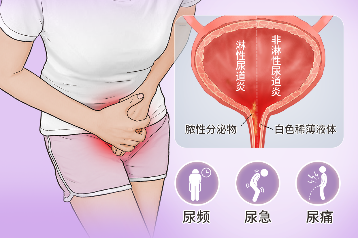 女性尿道炎症状图片