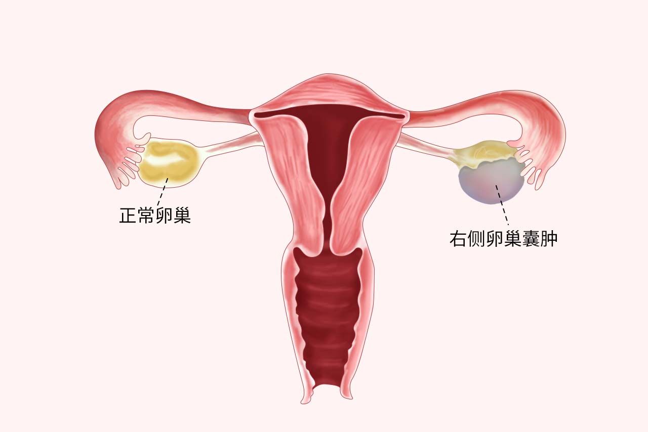 卵巢囊肿的位置图片图片