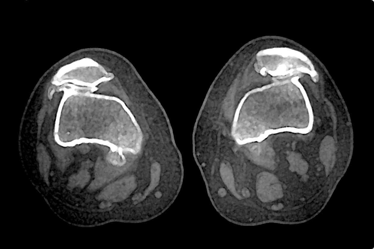 髕骨骨關節炎x線圖片