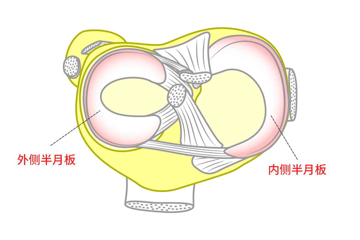 為股骨髁和脛骨平臺之間的纖維軟骨板,其通常可分為內側和外側半月板