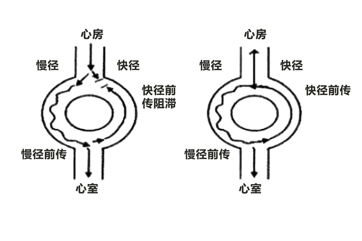 房室結折返性心動過速示意圖