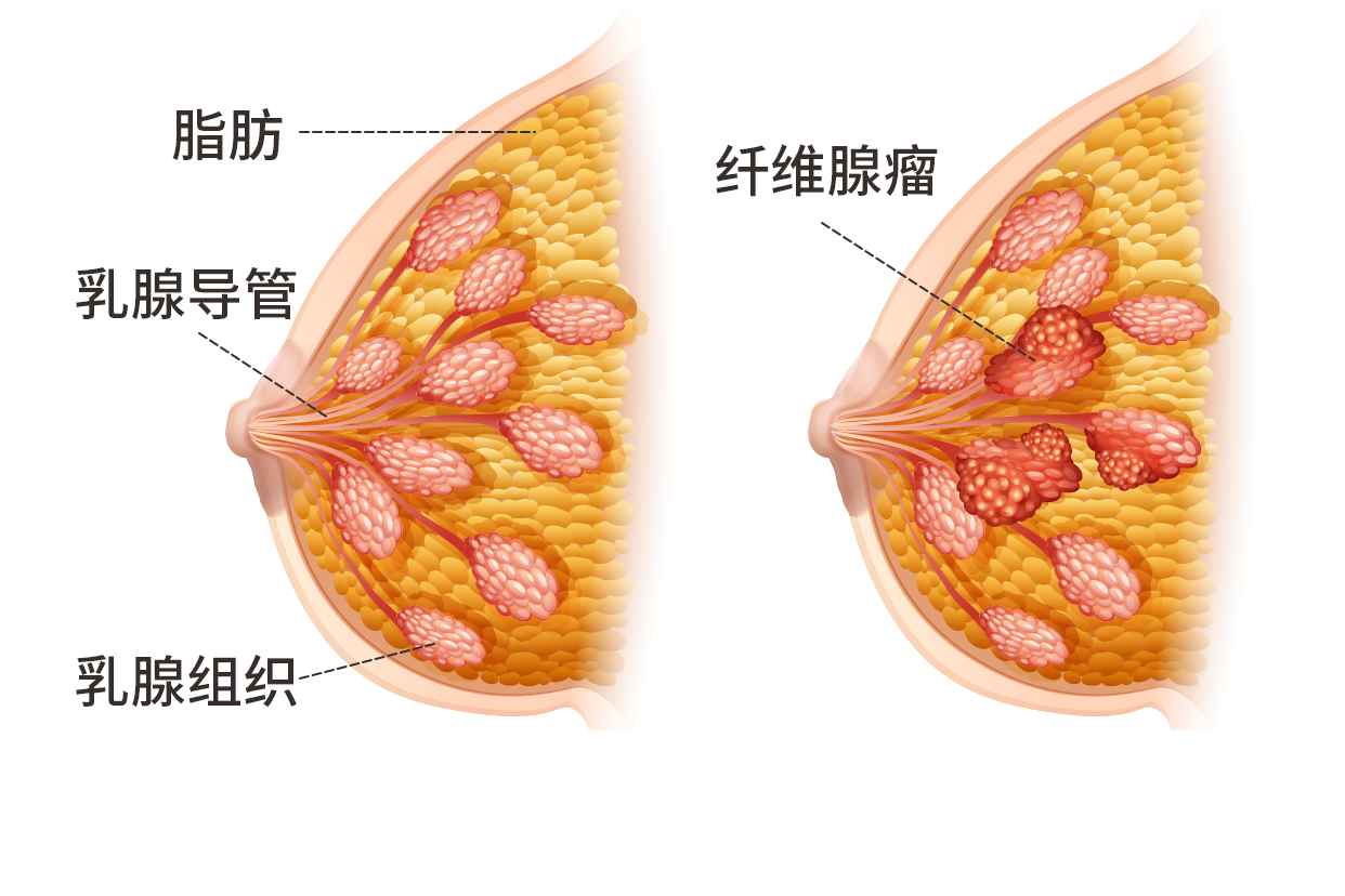 本病病因尚不十分明確,可能是乳腺小葉內纖維細胞對雌激素的敏感性