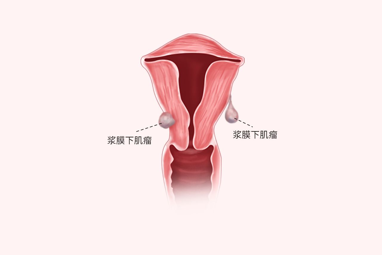 子宫肌瘤压迫直肠图片图片