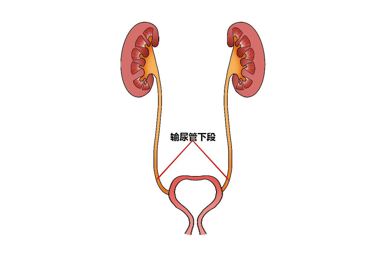 輸尿管下段位置圖