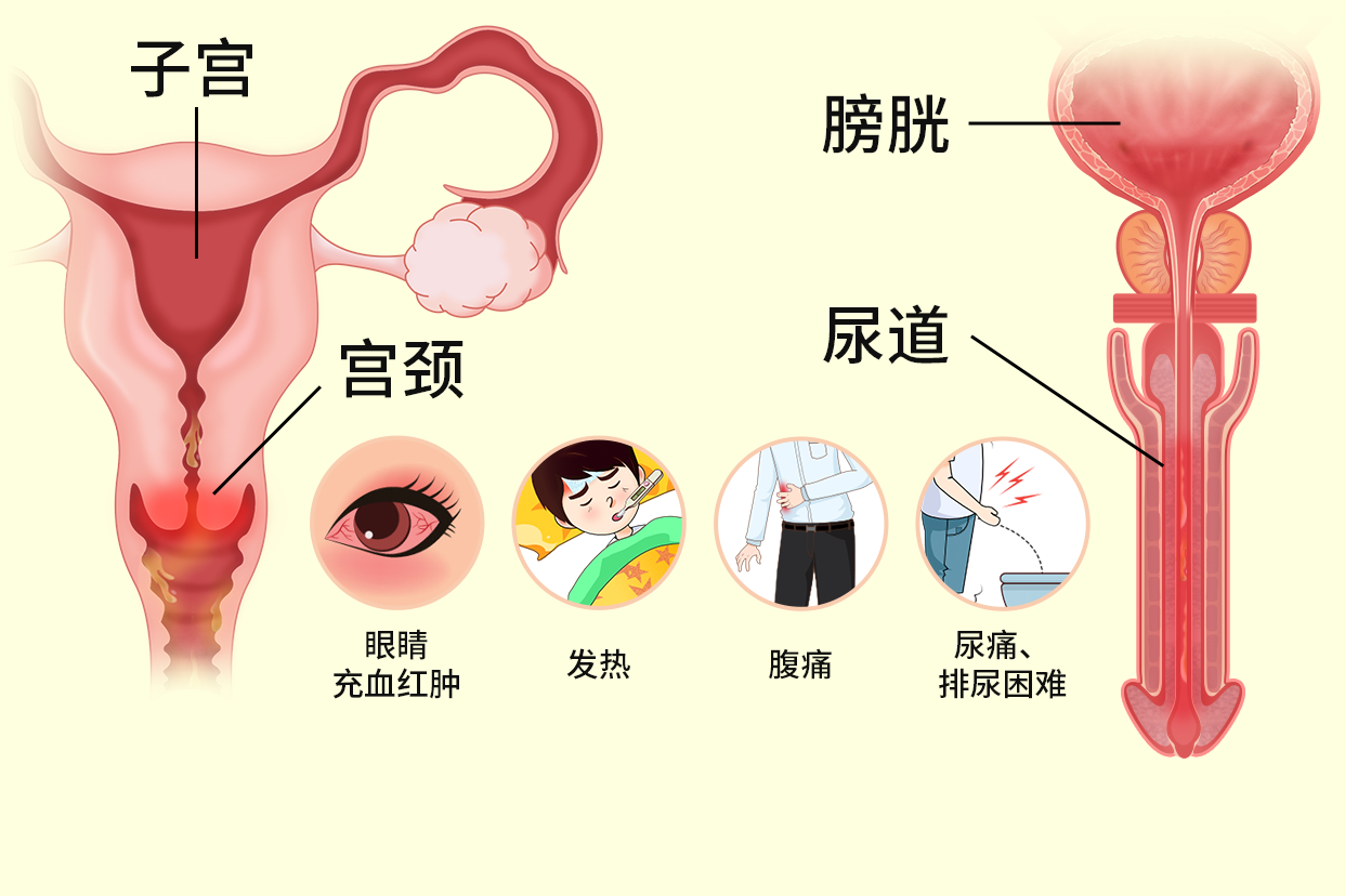 淋病是一种泌尿生殖系统化脓性感染性疾病,是由淋病奈瑟菌感染引起