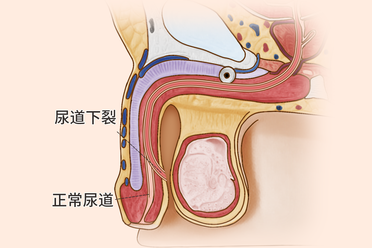 尿道下裂阴囊型图片