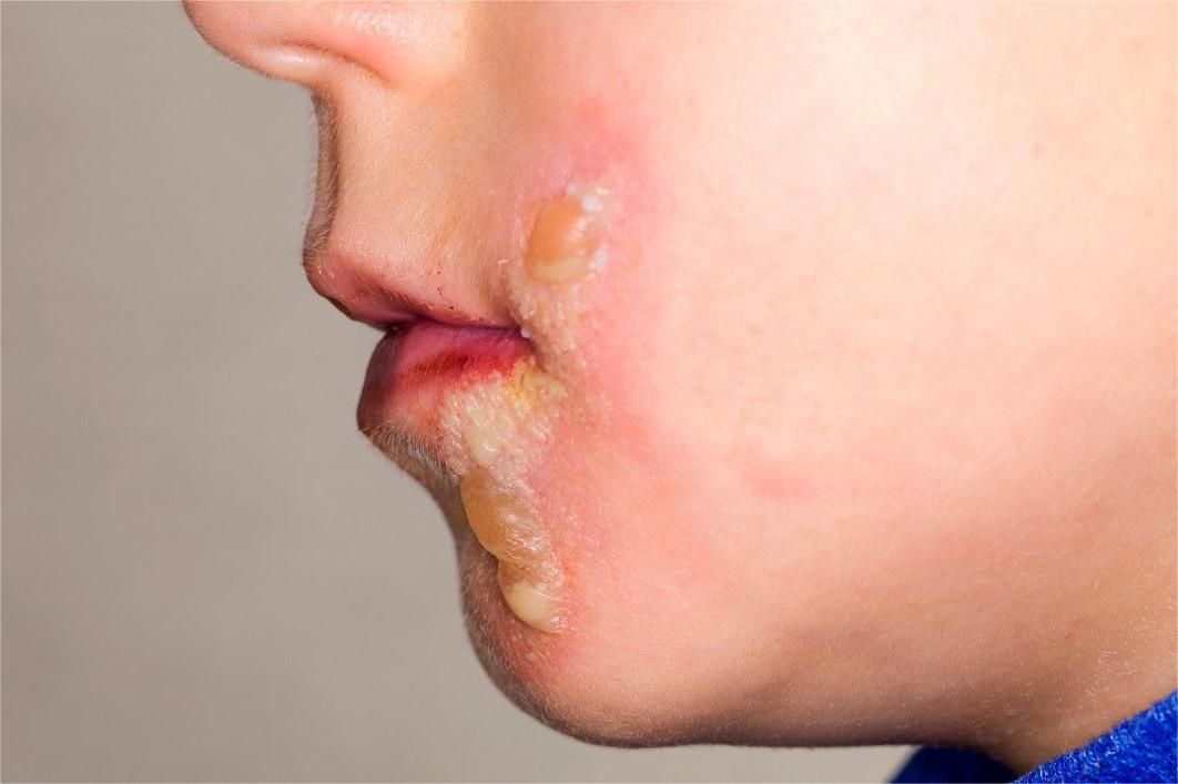 烫伤,过敏反应,自身免疫异常,以及细菌,病毒或真菌感染等因素有关