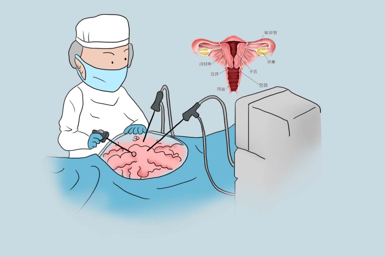 子宫全切手术过程图片