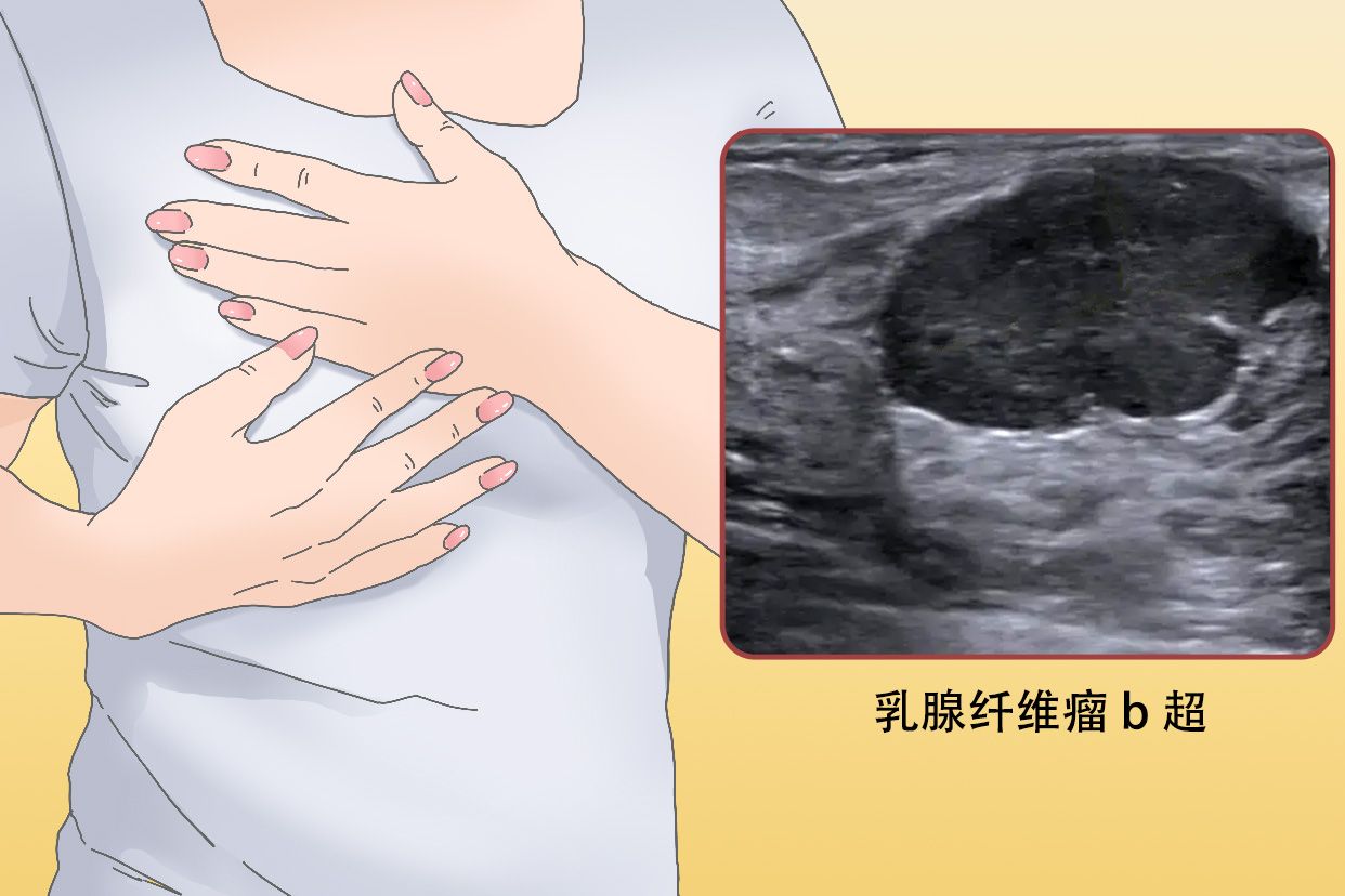 乳房良性纤维瘤图片