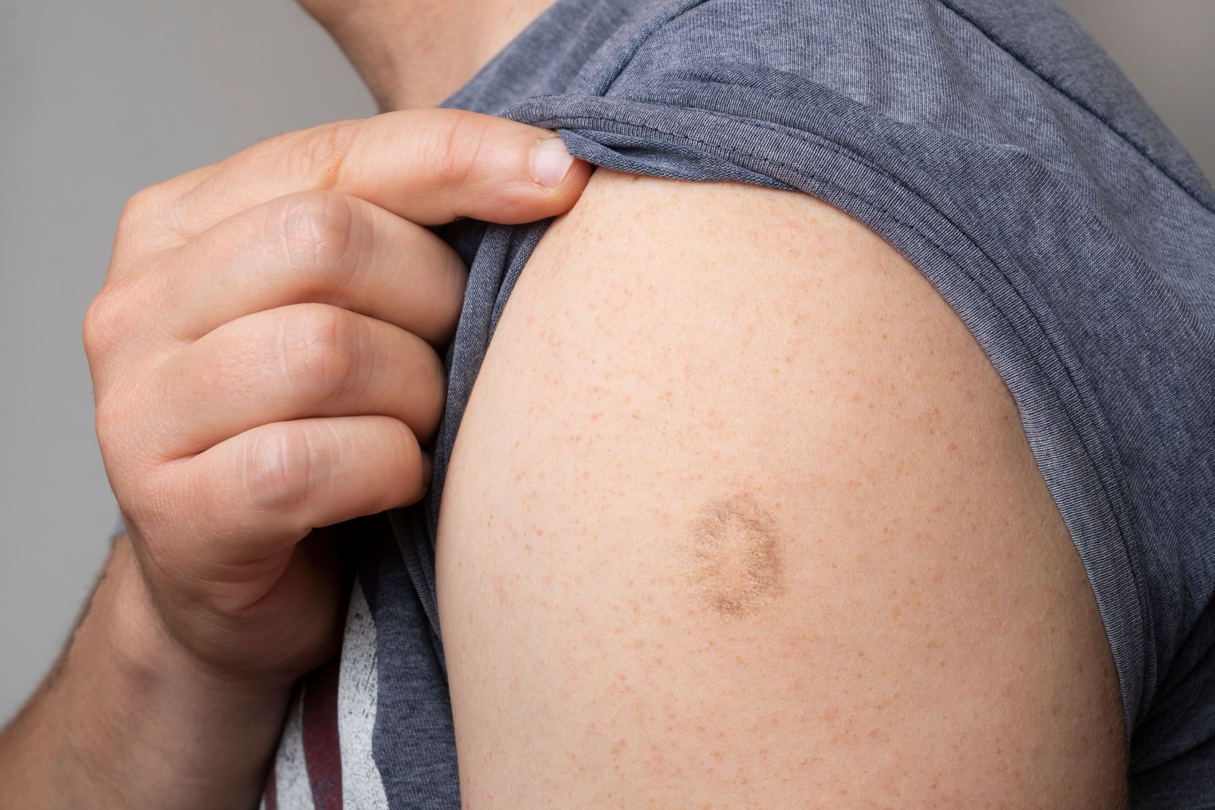 天花疫苗为什么有疤痕图片
