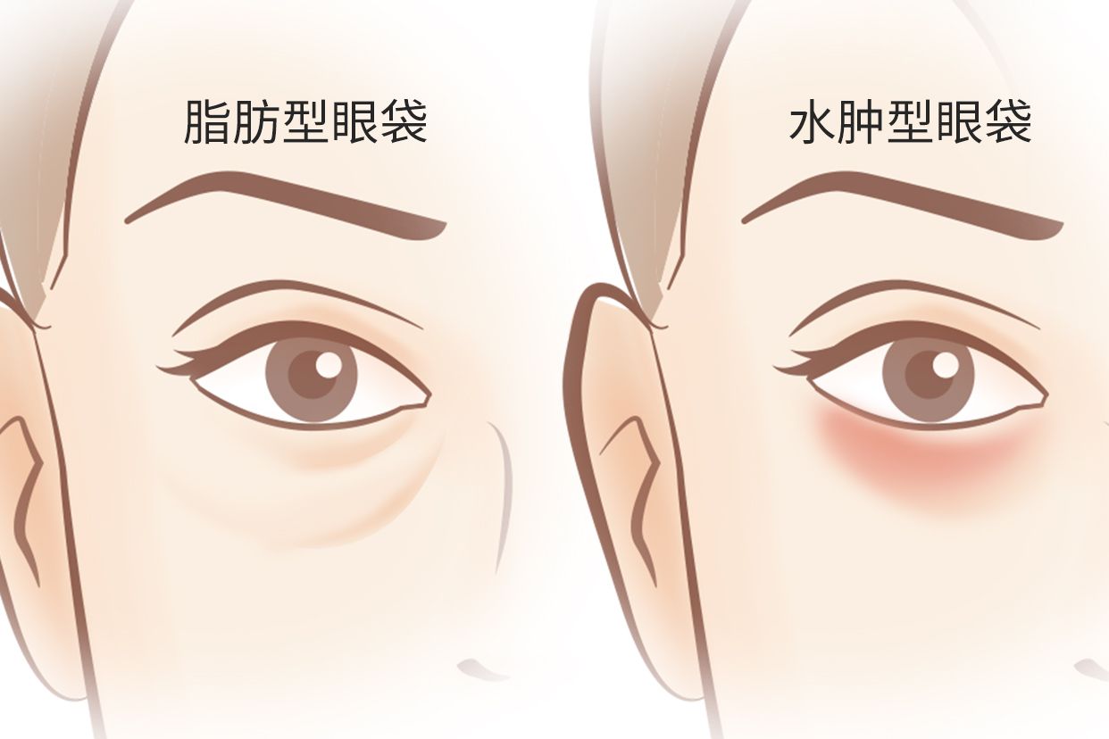 脂肪型眼袋和水腫型眼袋區別圖