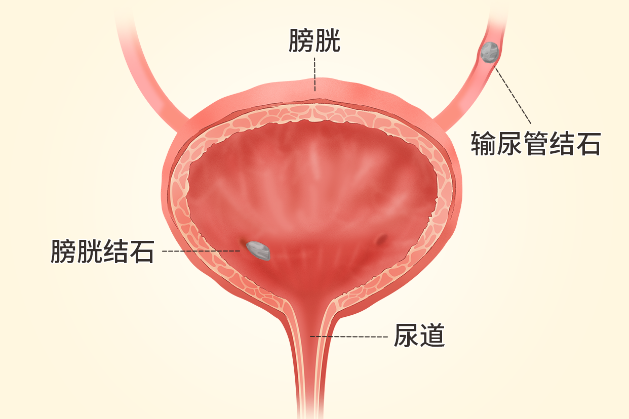 输尿管膀胱入口位置图图片