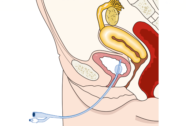 女性患者留置导尿术的操作流程主要分为导尿前准备,消毒,插管导尿