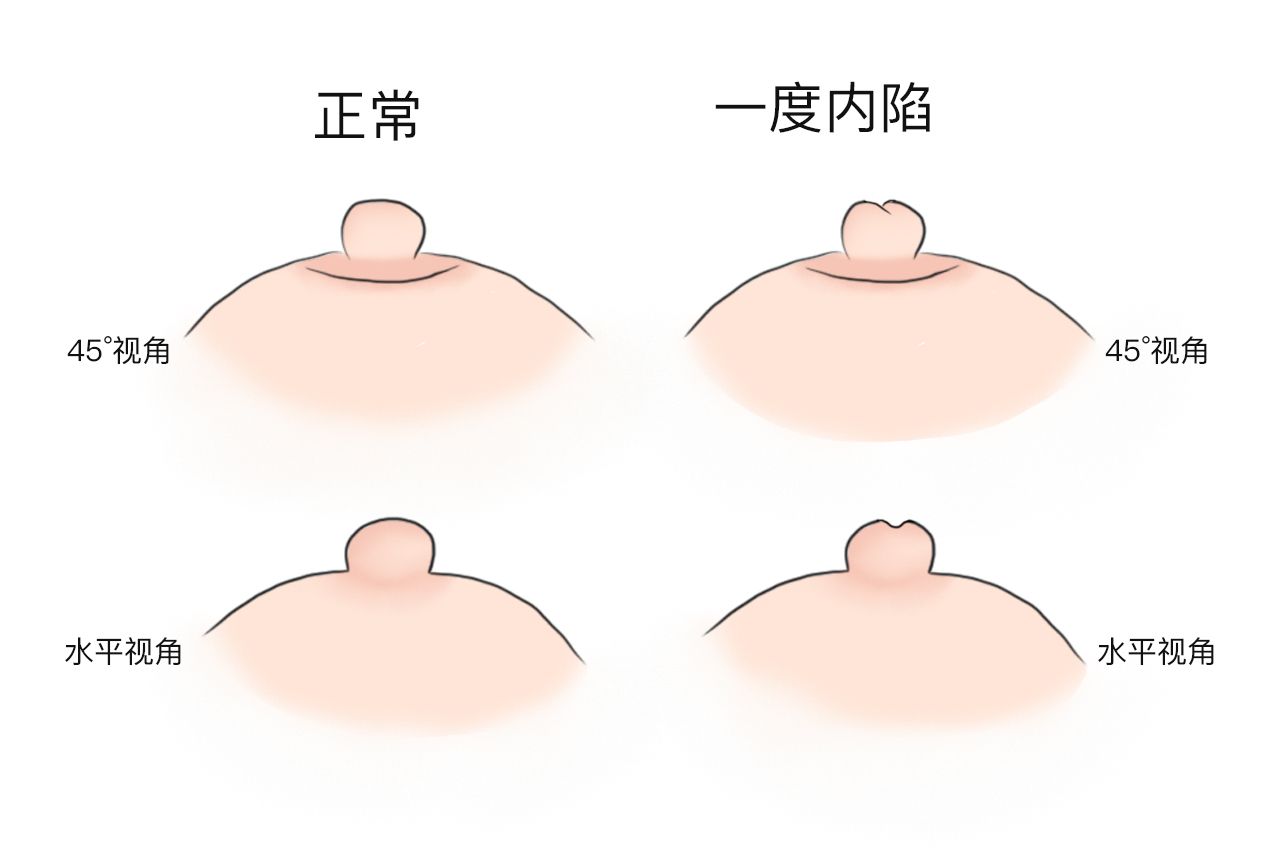 乳头正常突出凸起图片