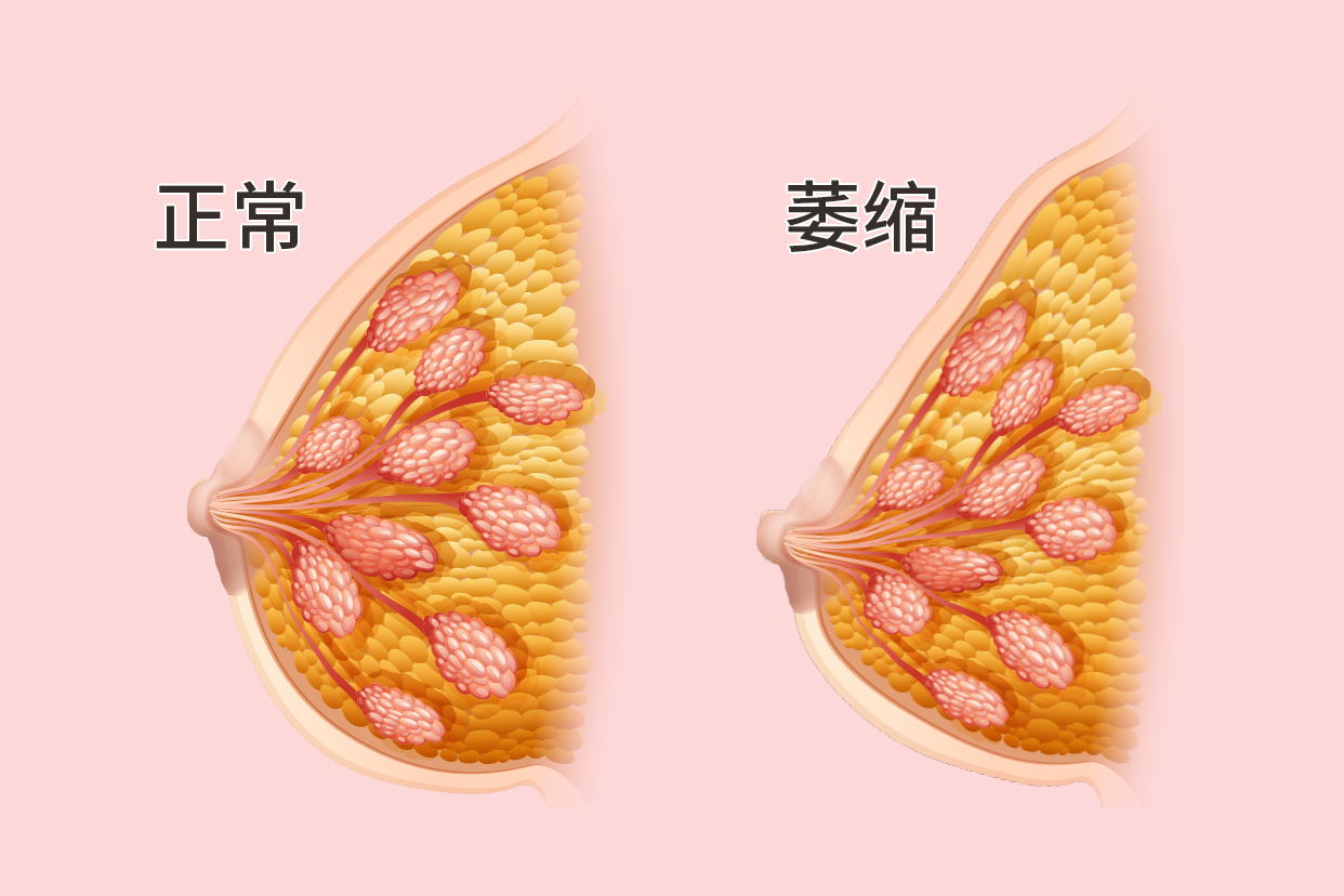乳房早期桔子皮状图片图片