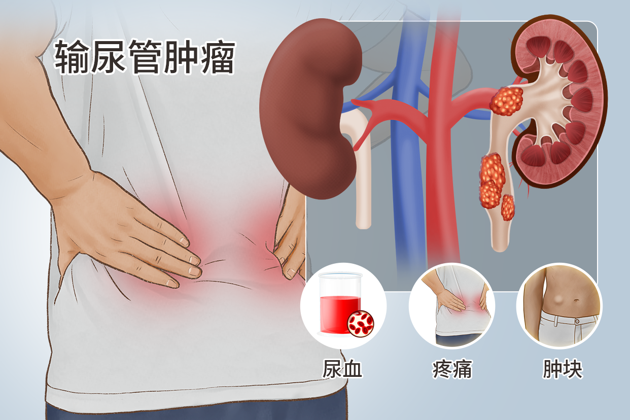 输尿管肿瘤图片