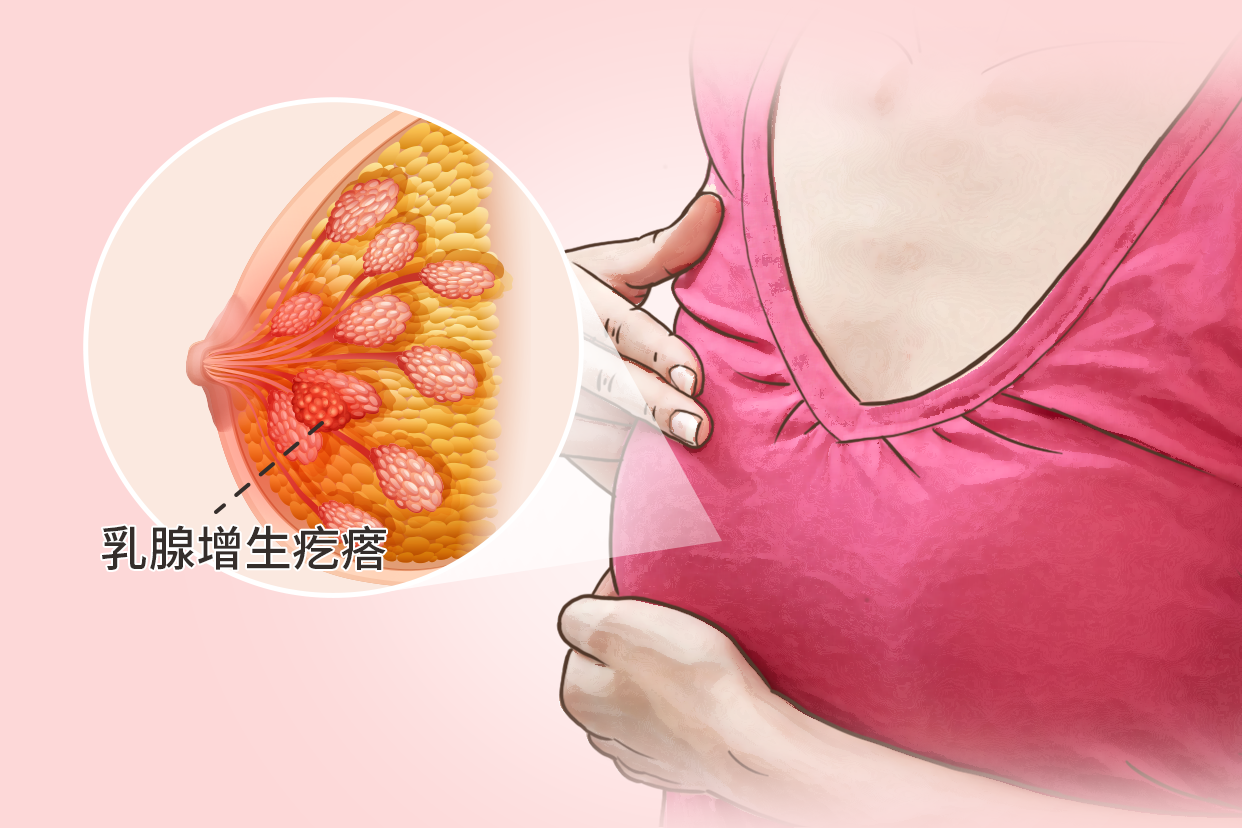 乳腺纤维瘤,是一种常见的良性肿瘤,大多没有明显的症状,而且增长不