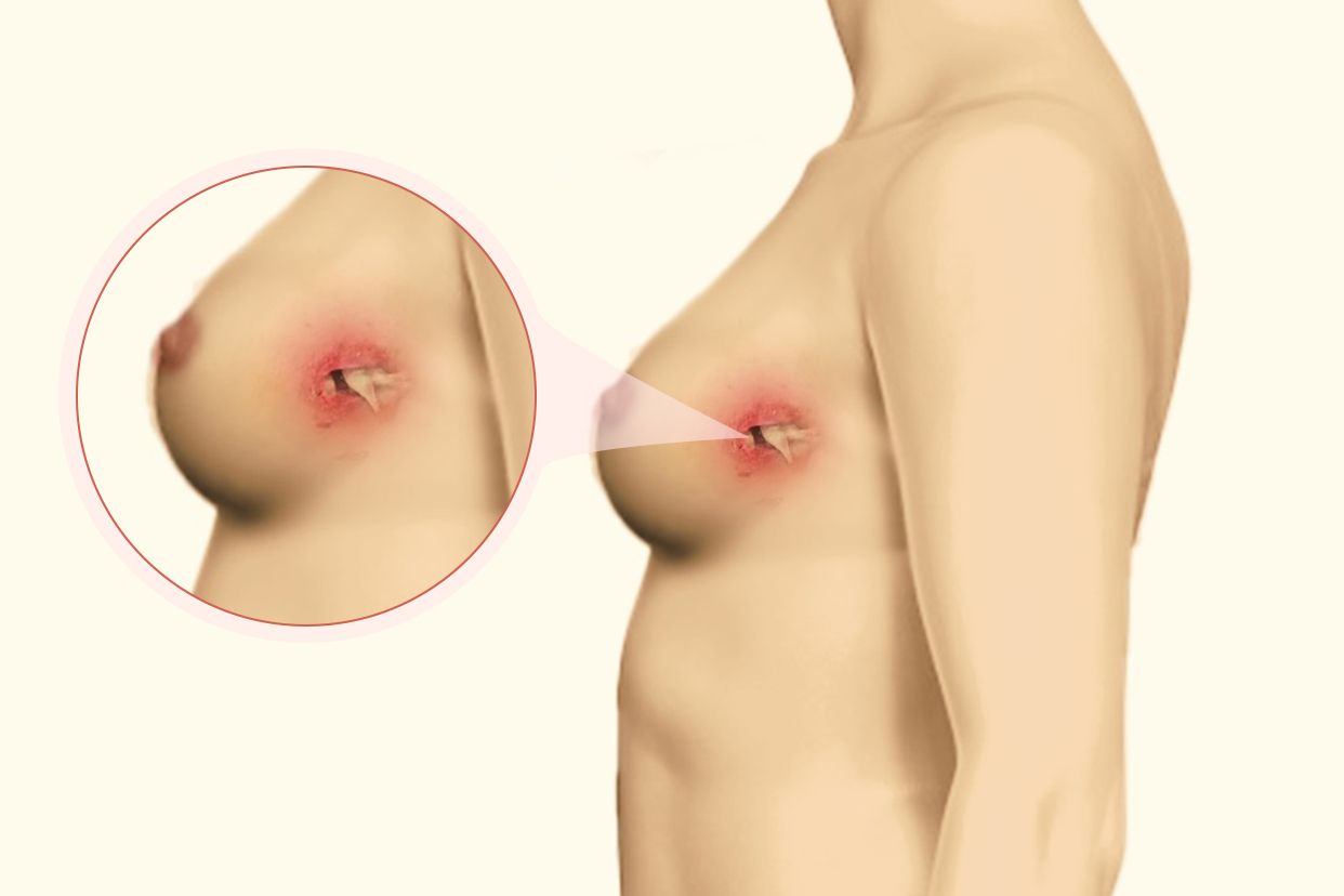 乳腺癌早期皮肤溃烂图