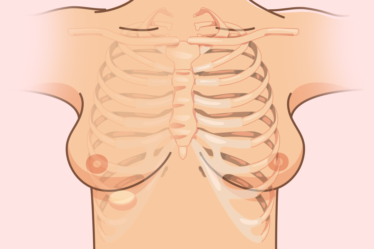 乳房下面肋骨处有个包图片
